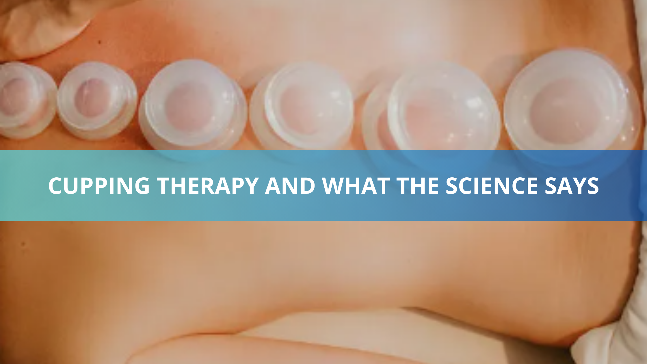 CUPPING THERAPY: WHAT THE SCIENCE SAYS
